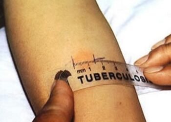 Tuberculosis: ¿una nueva pandemia?